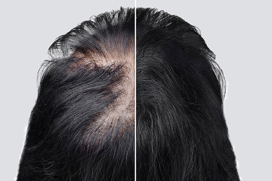 دلایل ریزش موی زنان بالای ۴۰ سال