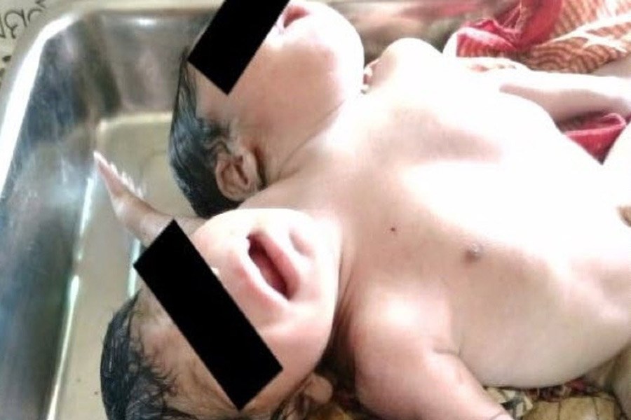 تولد یک نوزاد با دو سر و سه دست!