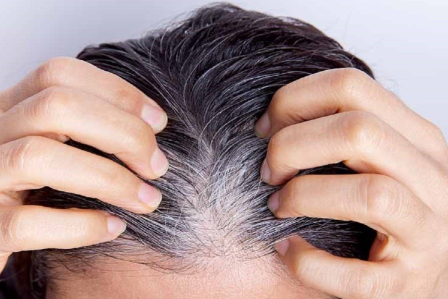 تصویر نسخه‌های طبیعی برای درمان ریزش و سفیدی مو