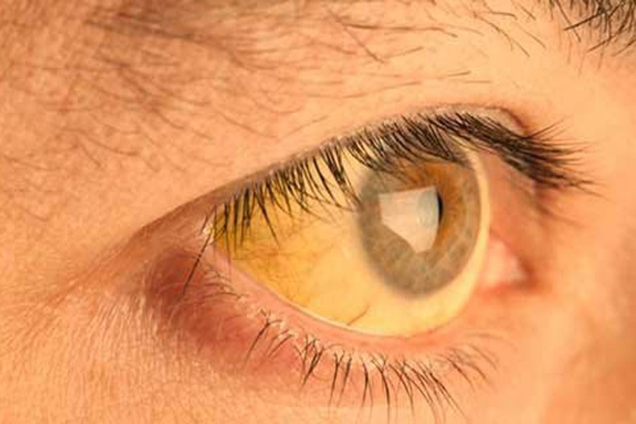 تصویر هاله زرد رنگ اطراف چشم نشانه چیست؟