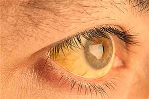 هاله زرد رنگ اطراف چشم نشانه چیست؟