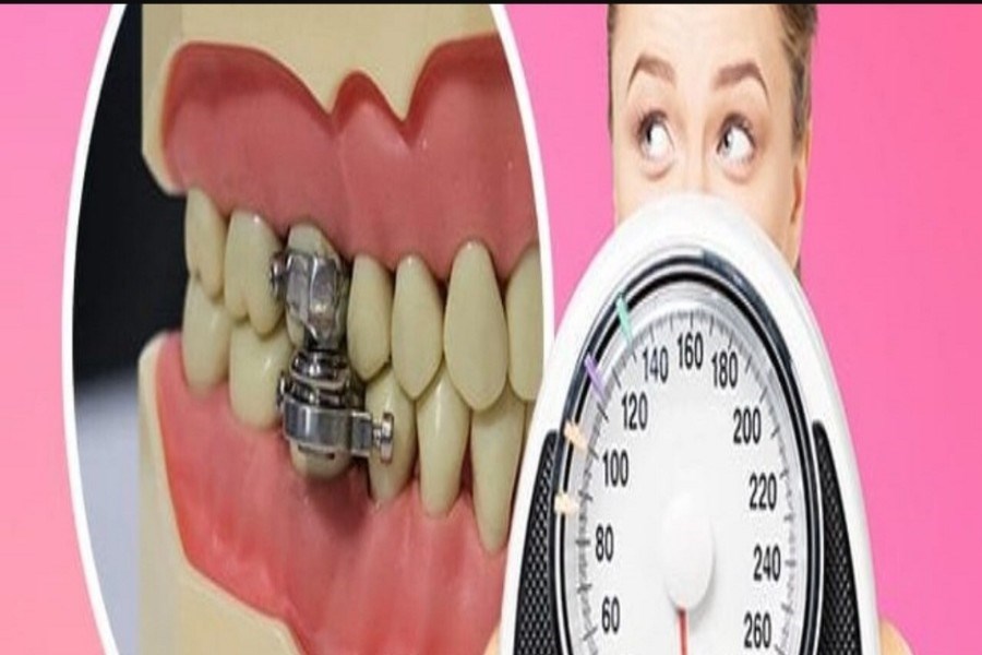 تصویر ابزار جدیدی برای کاهش وزن که از زیاد باز شدن دهان جلوگیری می‌کند!