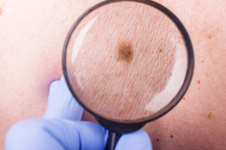 تصویر درمان مرگبارترین نوع سرطان پوست با آنتی‌بیوتیک