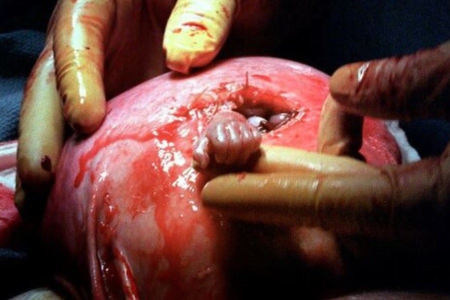 تصویر جنینی که پیش از تولد دست جراحش را فشرد