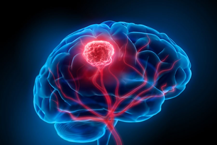 تصویر کوچک کردن تومور مغزی با کلاه مغناطیسی ممکن شد