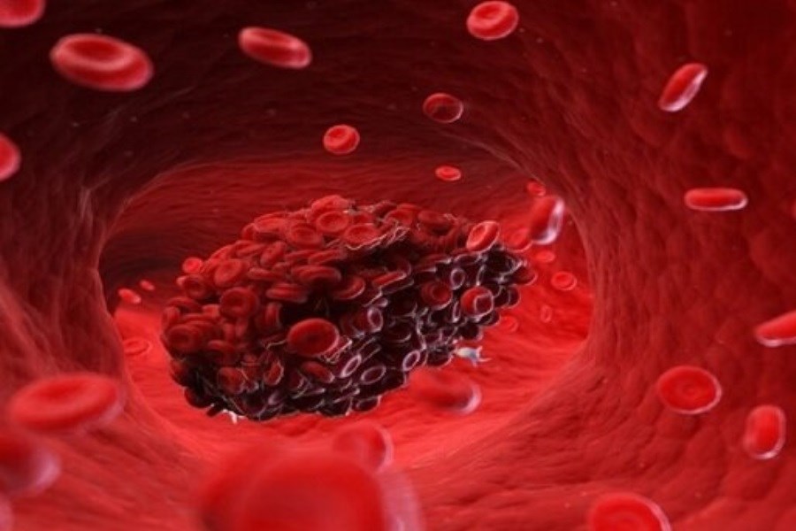 تصویر مهمترین علائم اولیه لخته شدن خون