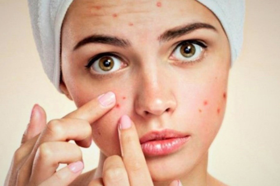 روش های شگفت انگیز برای درمان جوش صورت