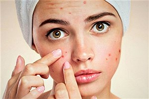 روش های شگفت انگیز برای درمان جوش صورت