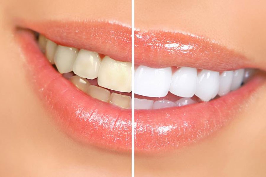 تصویر تاثیر مخرب محصولات سفید کننده بر دندان‌ها