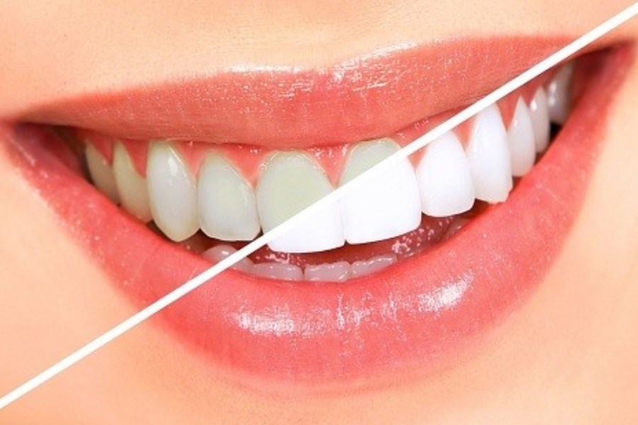 تصویر 6 علت ساده در زرد شدن دندان ها