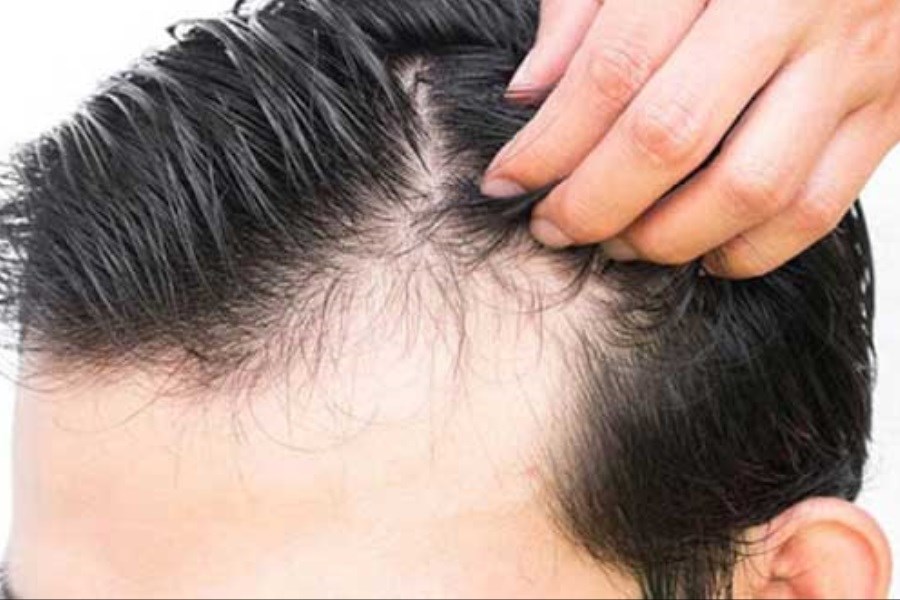 تصویر راه درمان ریزش مو پس از بیماری کرونا