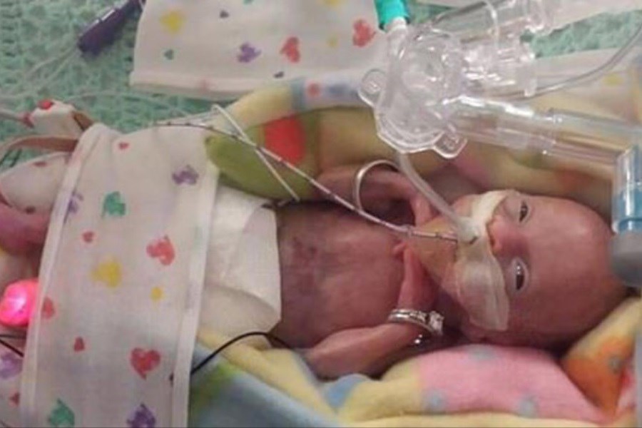 تصویر نارس ترین نوزاد دنیا متولد شد