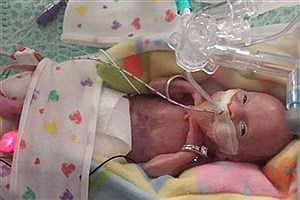 نارس ترین نوزاد دنیا متولد شد