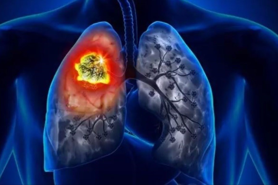 تصویر ارتباط آلودگی هوا با افزایش ابتلا به سرطان ریه