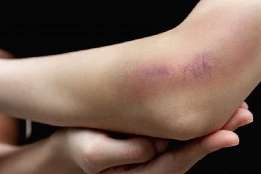 تصویر درمان خانگی کبودی پوست