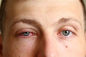 بیماری چشم صورتی و درمان آن