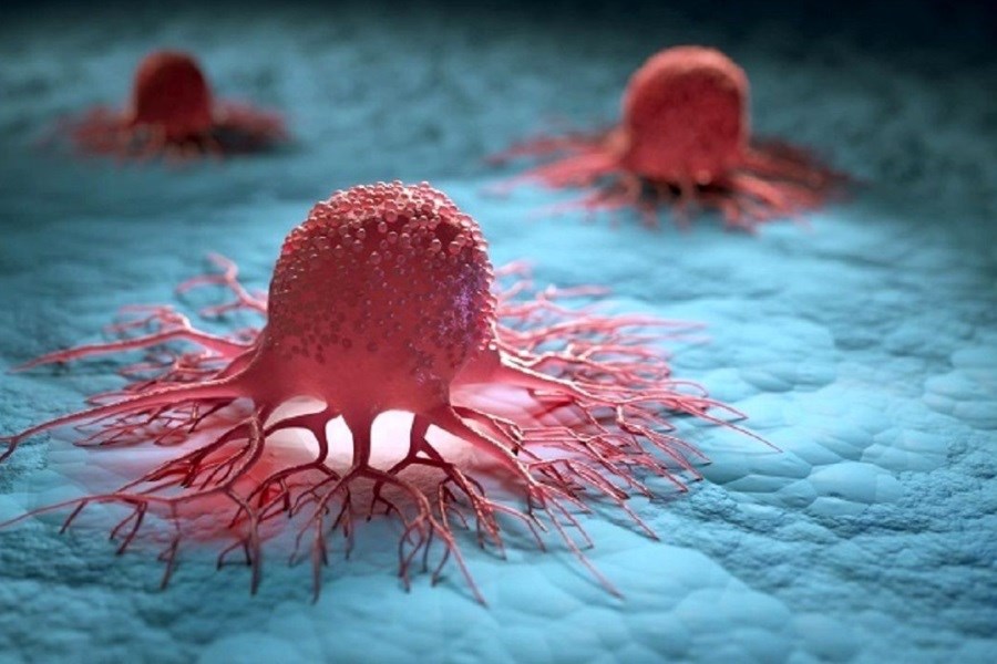 تصویر درمان سرطان سینه با روشی جدید