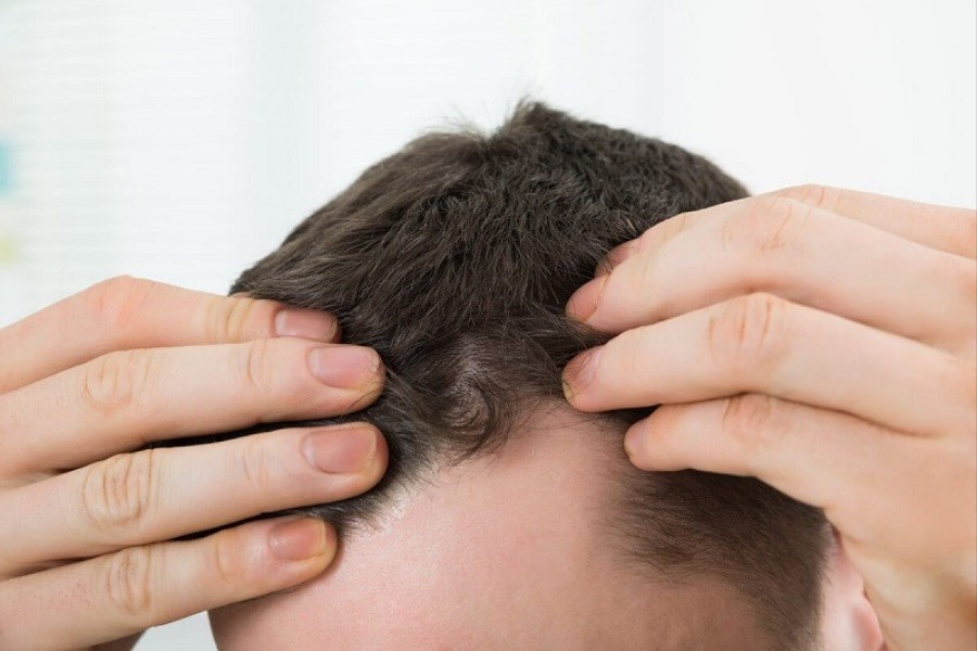 تصویر امیدی تازه برای رشد مو با یک داروی ارزان