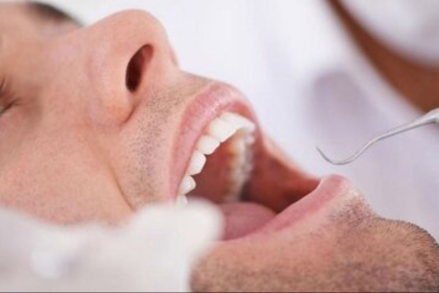 تصویر جرم‌گیری برای دندان‌ها مضر است؟