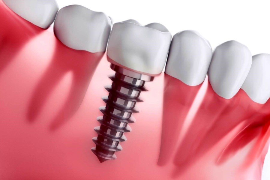 تصویر چرا ایمپلنت دندان بهترین راه جایگزینی دندان از دست رفته است؟