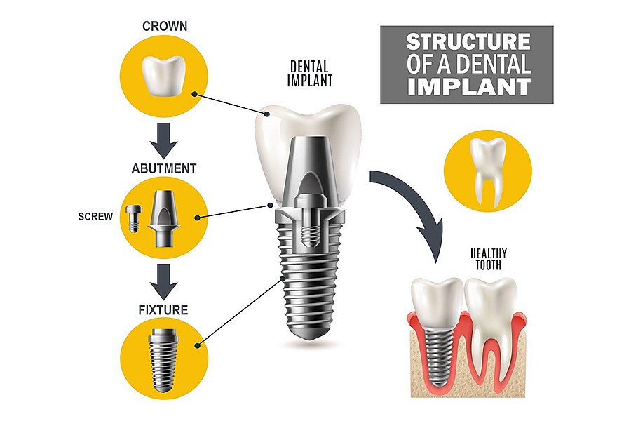تصویر اجزای ایمپلنت دندانی چیست؟