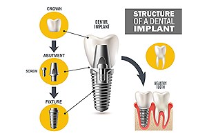 اجزای ایمپلنت دندانی چیست؟