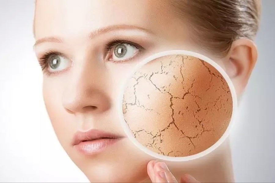 تصویر درمان خشکی پوست با چند روش آسان
