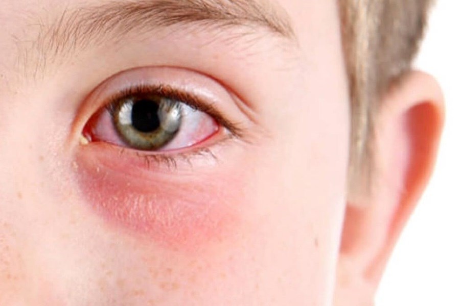کشف درمان جدید التهاب چشم