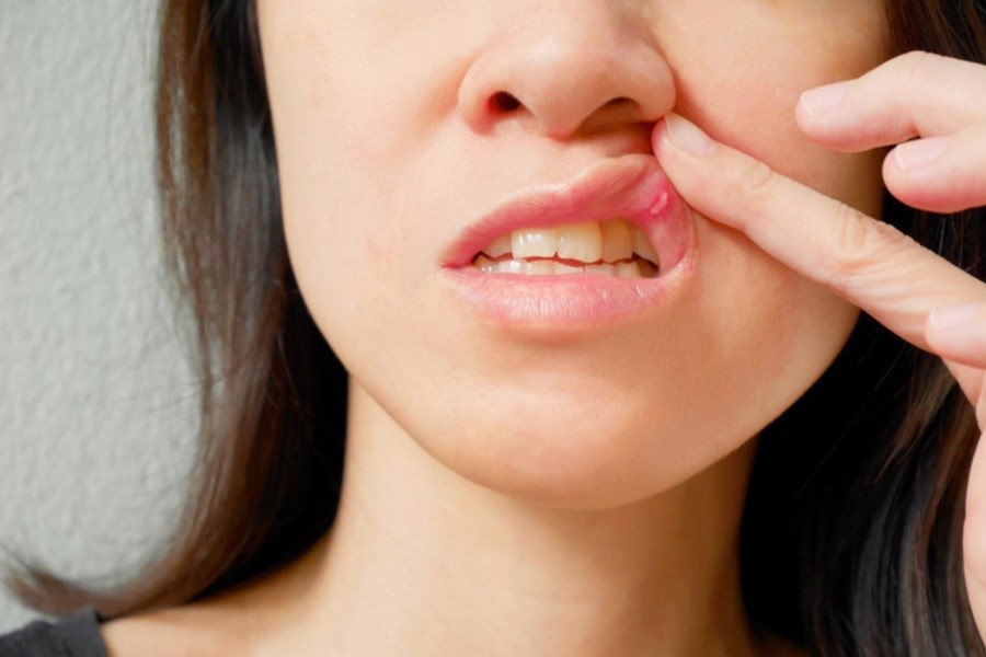برای آفت دهان چی خوبه؟ درمان سریع آفت دهان با 3+5 روش خانگی