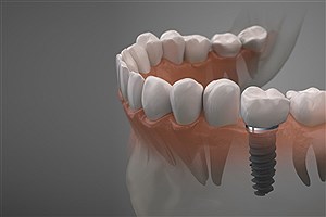 ایمپلنت دندان های آسیاب ( مزایا، مراحل + مدت زمان )