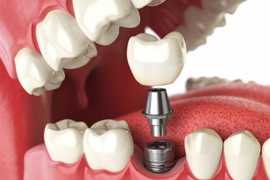 ایمپلنت دندان چطور انجام می‌شود؟