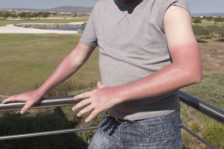 تصویر ۱۰ اشتباه رایج که عوارض آفتاب سوختگی را تشدید می‌کنند