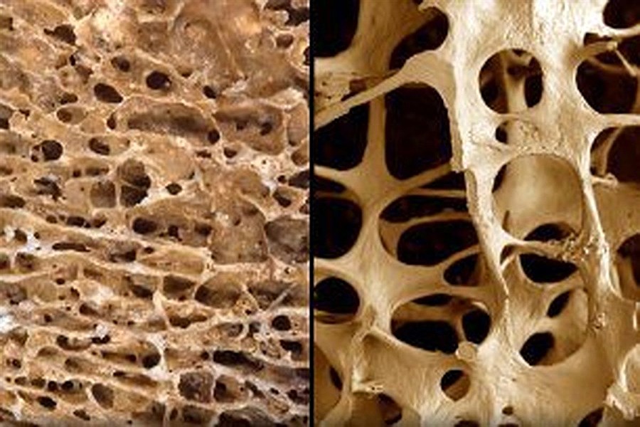 تصویر چطور ابتلا به پوکی استخوان را به تعویق بیندازیم؟