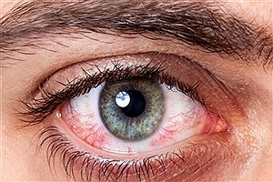 از عفونت تا کوری؛ عوارض شنا کردن با لنزهای چشمی