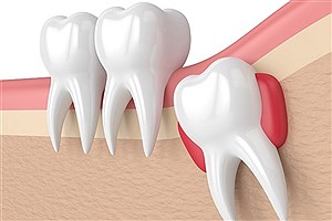 آیا باید دندان عقل نهفته را جراحی کرد؟