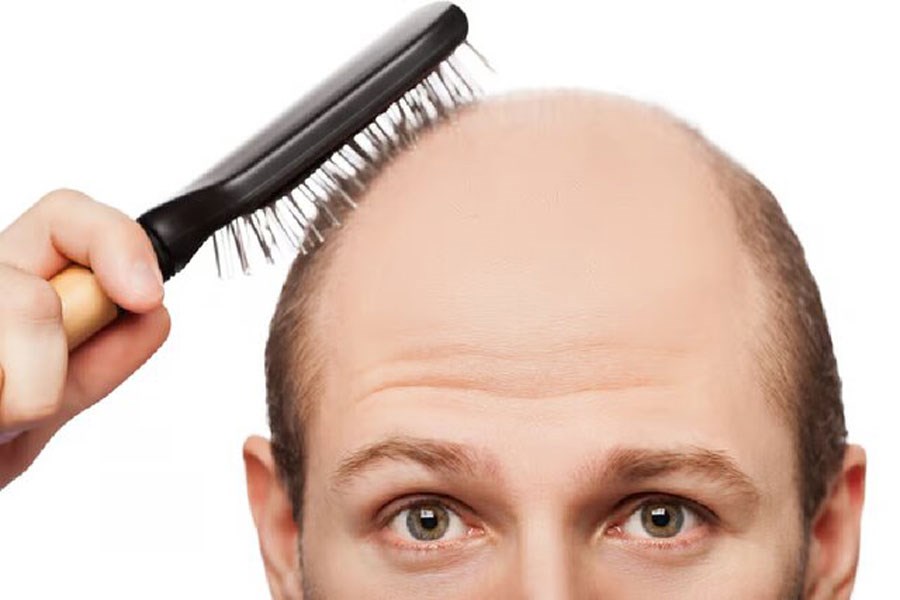 تصویر ژن‌های نادر عامل ریزش موی مردان شناسایی شدند