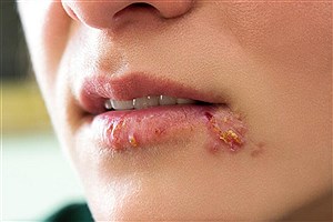 تبخال از شایع‌ترین بیماری‌های ویروسی دهان است