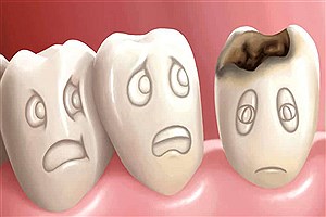 مهمترین عامل جلوگیری از پوسیدگی دندان