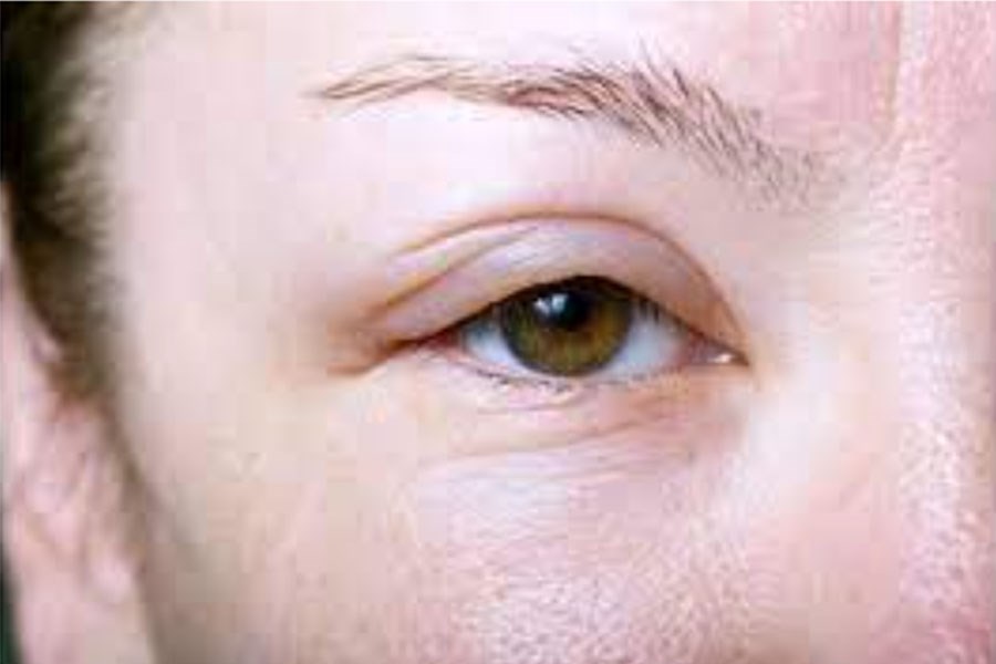 تصویر علل ورم صورت و التهاب زیر چشم چیست؟