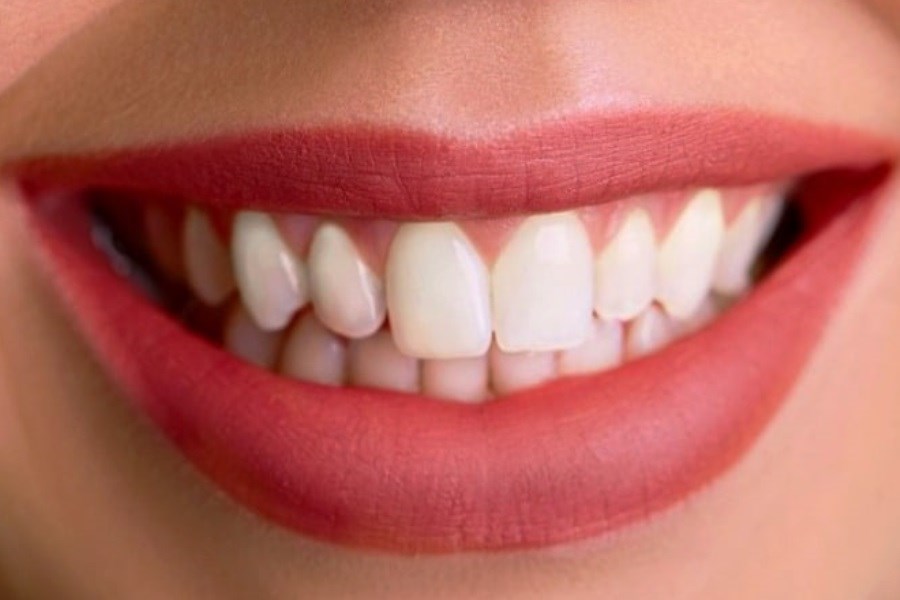 تصویر راز  داشتن دندان های سفید هالیوودی با سفید کننده های خانگی