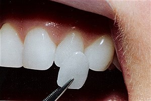 درباره لامینیت دندان چه می دانیم؟&#47;عمر لامینیت‌ها چه مدت است؟