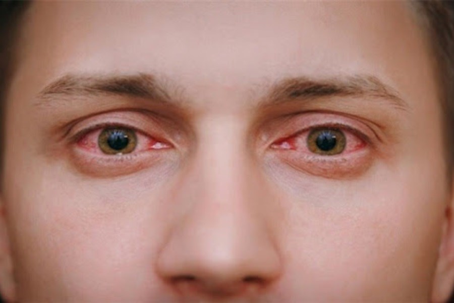 تصویر قرمزی چشم نشان دهنده بیماری در بدن