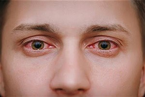 قرمزی چشم نشان دهنده بیماری در بدن