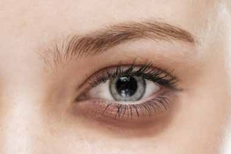 تصویر سیاهی دور چشم نشانه کمبود چه ویتامینی است؟