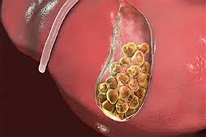 تشکیل سنگ کیسه صفرا به چه دلیل است؟ + فیلم