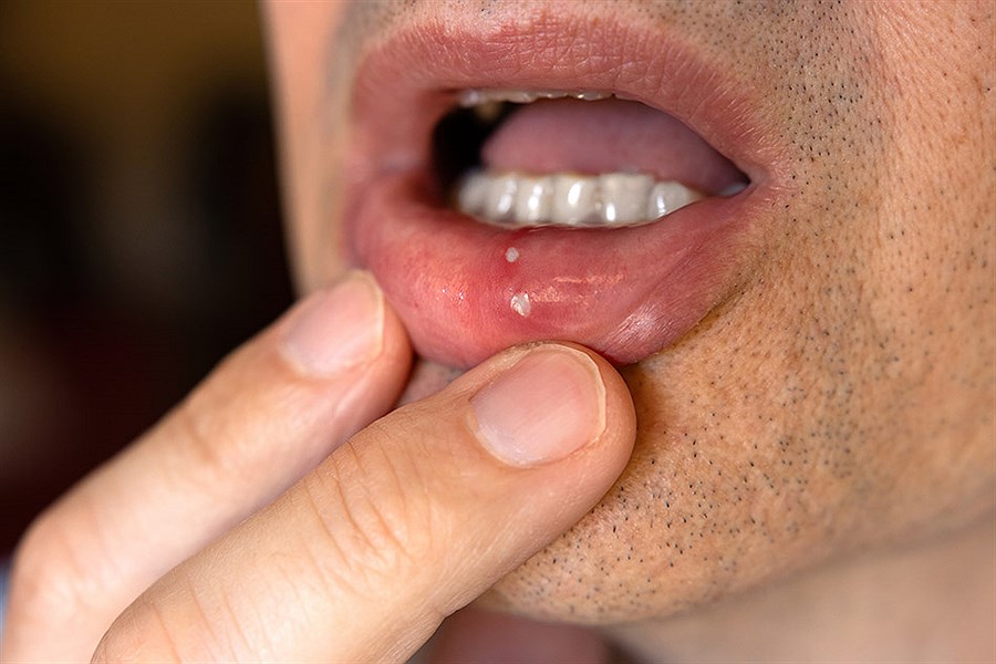 تصویر علائم آفت دهان چیست+ پیشگیری و درمان