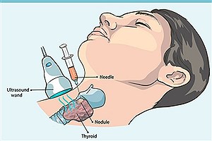 آزمایش FNA تیروئید چیست؟ علائم تشخیص گره و ندول های تیروئید &#47;جزئیات