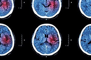 خونریزی مغزی خطر ابتلا به زوال عقل را افزایش می دهد