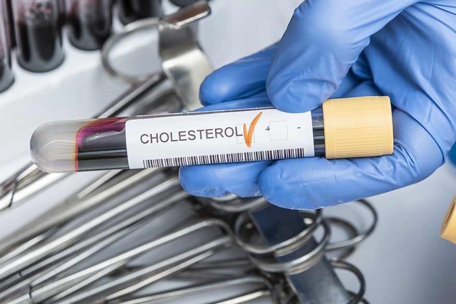 تصویر آزمایش Cholesterol + شرایط انجام آن