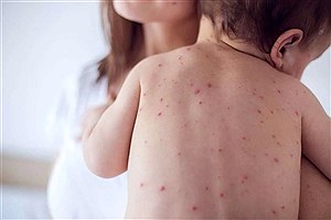 زنگ خطر ابتلا به سرخک در کودکان زیر پنج سال